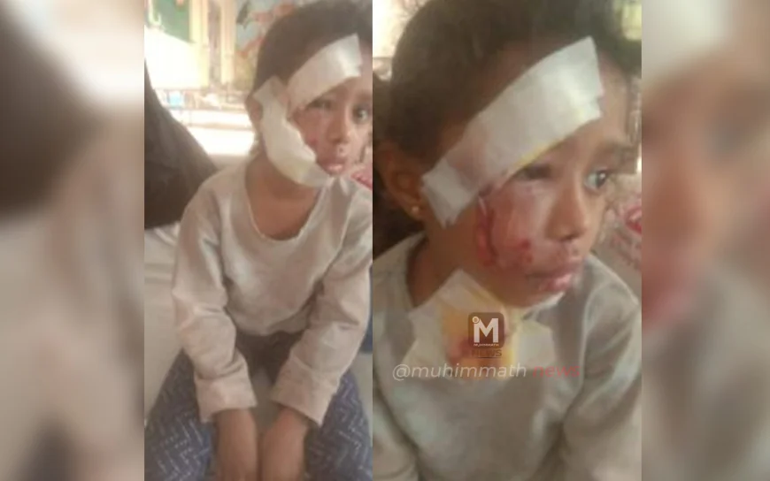 ಸ್ಥಳೀಯ ಆಡಳಿತದ ನಿರ್ಲಕ್ಷ್ಯ: ಅಂಗನವಾಡಿಗೆ ಹೋಗುವ ವೇಳೆ ಮಗುವಿನ ಮೇಲೆ ದಾಳಿ ಮಾಡಿದ ಬೀದಿ ನಾಯಿ