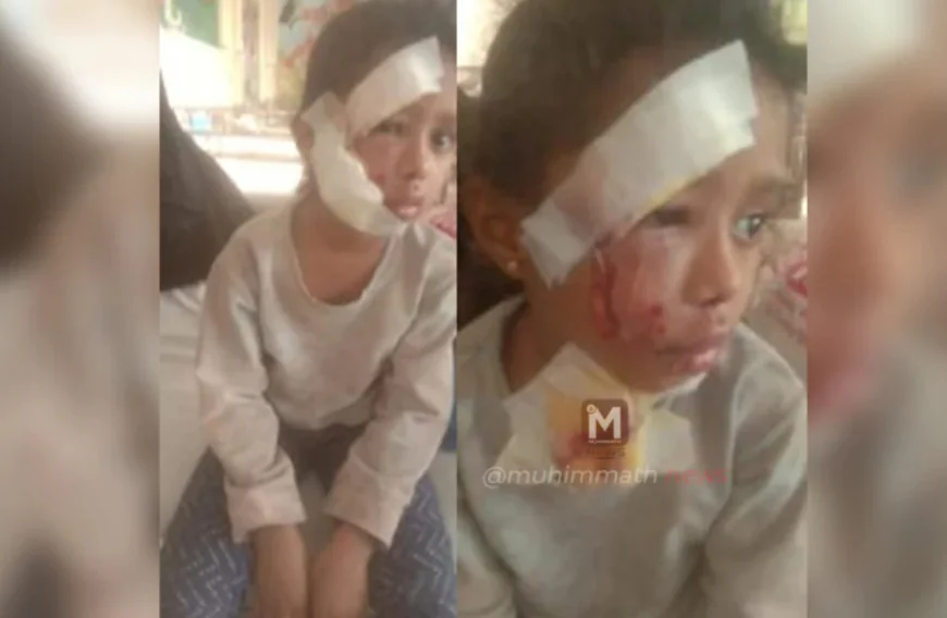 അങ്കണവാടിയിലേക്ക് പോകുന്നതിനിടെ തെരുവ് നായ ആക്രമണം; നാലു വയസ്സുകാരിക്ക് ഗുരുതര പരിക്ക്